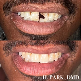 Before and after smile at Singing River Dentistry