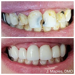 Before and after smile at Singing River Dentistry