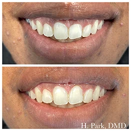 Before and after smile at Singing River Dentistry