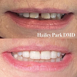 Before and after smile at Singing River Dentistry