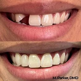 Before and after smile at Singing River Dentistry