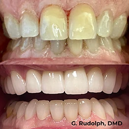 Before and after smile at Singing River Dentistry