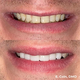 Before and after smile at Singing River Dentistry