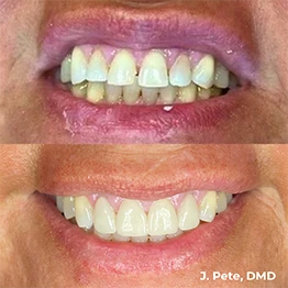 Before and after smile at Singing River Dentistry