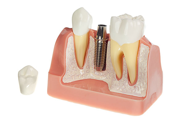 digital model of titanium screw of dental implant between two teeth with the dental crown off to the side digital model of titanium screw of dental implant between two teeth with the dental crown off to the side