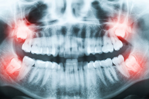 Photo of wisdom teeth xray atSinging River Dentistry in Athens, AL