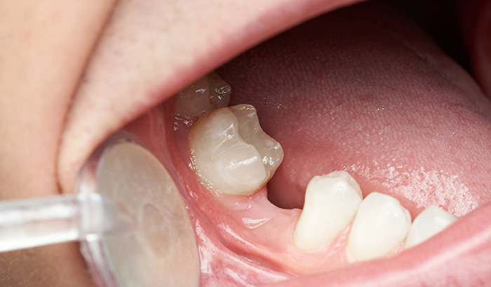 Zoomed in image of a missing tooth during a dental exam at Singing River Dentistry in Madison, AL Zoomed in image of a missing tooth during a dental exam at Singing River Dentistry in Madison, AL