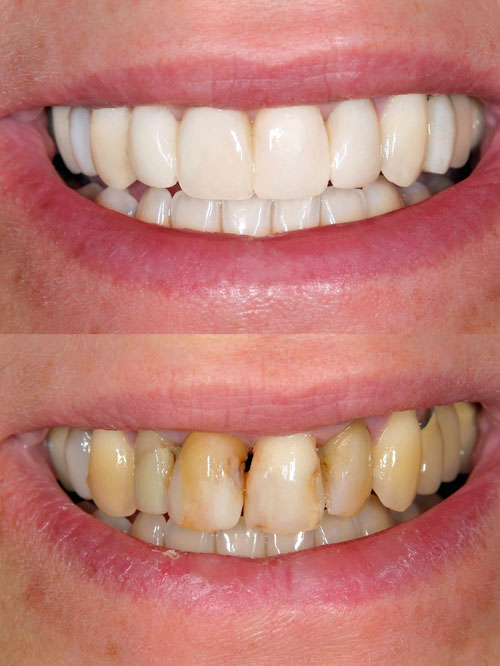 dental veneers for decay before and after dental veneers for decay before and after